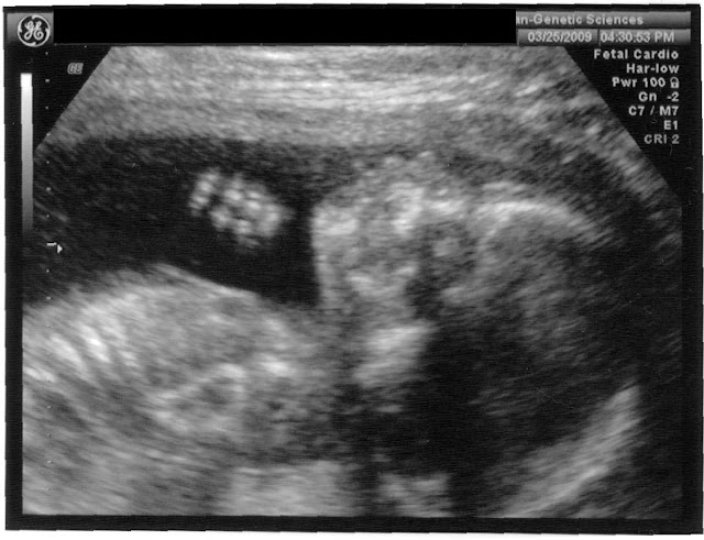 Marion 20 weeks