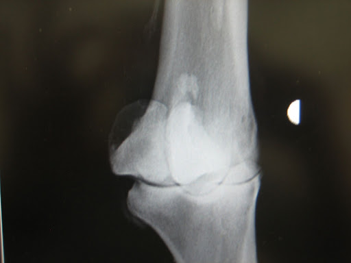 ligament