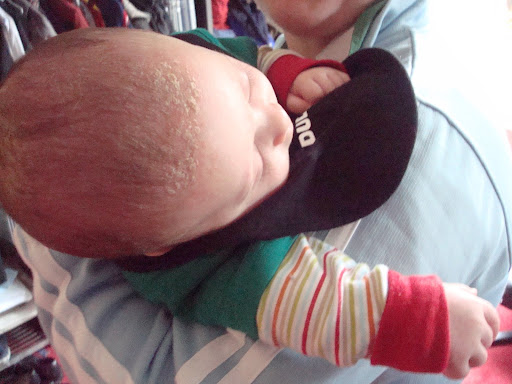 cradle cap