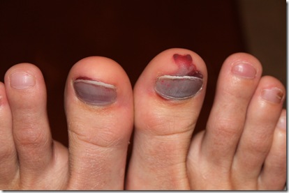 my poor toes 10-2-2010 7-19-39 PM my poor toes 10-2-2010 7-19-39 PM