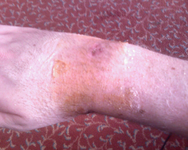 Arm with no pins