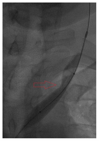 [LIJV partial inflate 01[2].jpg]