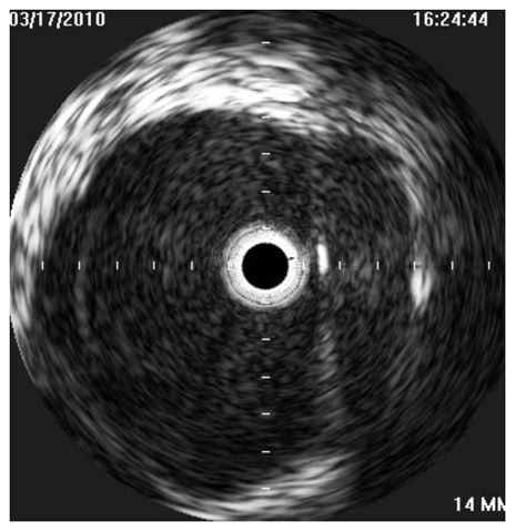 [IVUS bad valve 1[5].jpg]