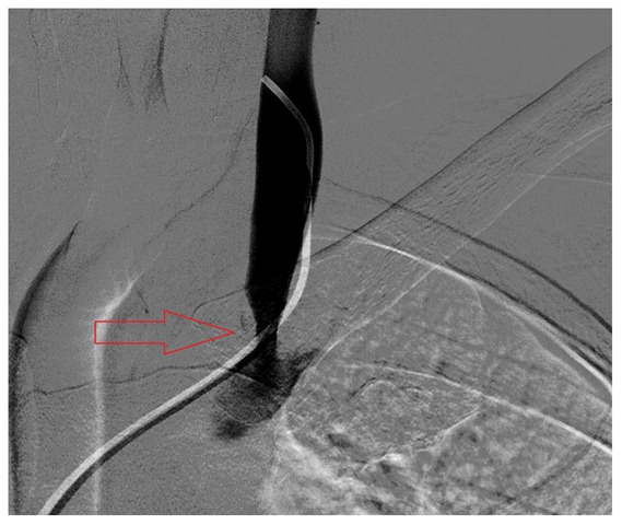 [LIJVstenosis013.jpg]