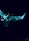 Él me dio esto (brazalete de pie) por mi cumpleaños – Me dio esto (fractura) por nada
Feb.08 - City of Hope | Emiratos Árabes Unidos
