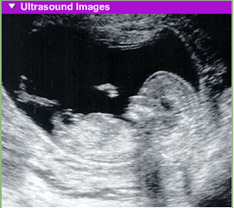 fetal development 3rd month usg