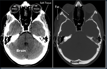 CT scan dan MRI normal