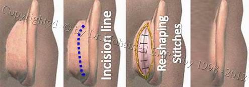 steps of ear repair steps of ear repair