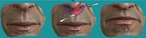 lip reduction lip reduction