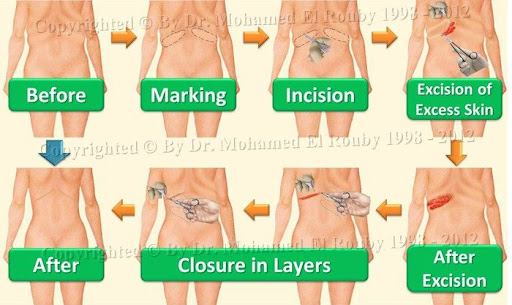 surgical reduction of back rolls surgical reduction of back rolls