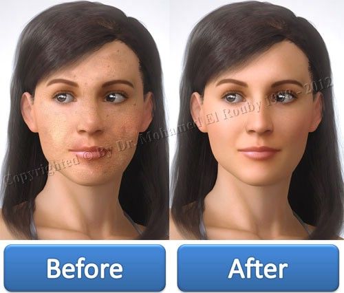 before and after peel before and after peel