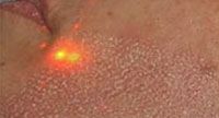 laser resufacing laser resufacing