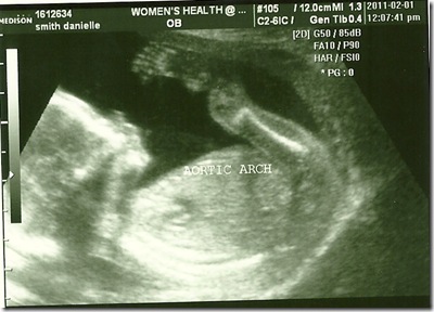 baby 2 - girl 18 wks