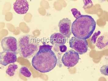 [megaloblastic anemia -sickle cell anemia[2].jpg]