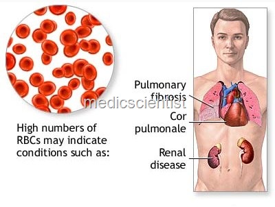 [Polycythemia Vera 2[3].jpg]