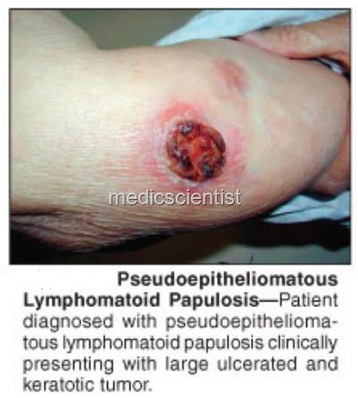 [Lymphoid Malignancies gr[2].jpg]