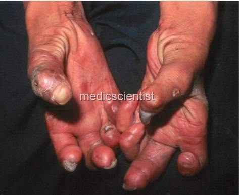 [Complications of Leprosy Extremities[2].jpg]