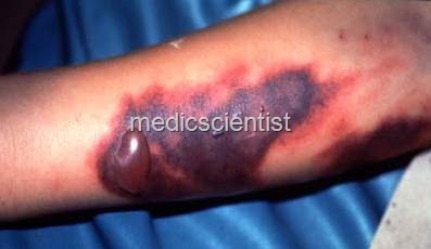 [Dengue ed[2].jpg]