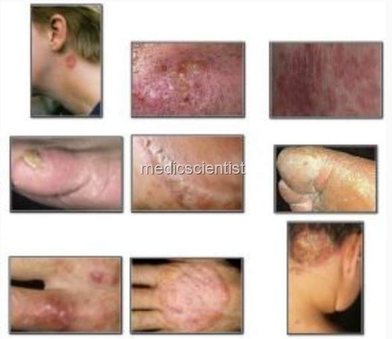 [Fungal Infections YH[2].jpg]