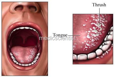 [Candida growsIU[2].jpg]