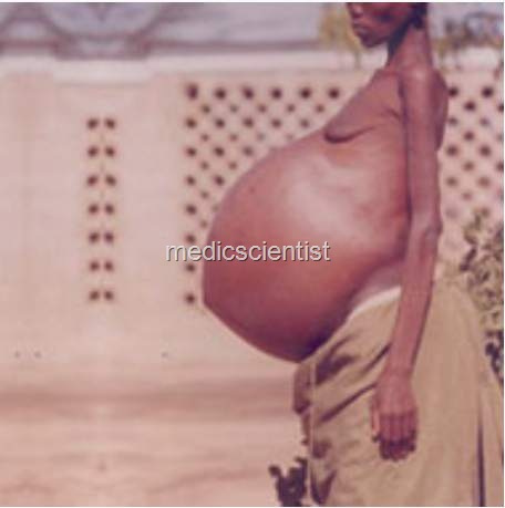 [ECHINOCOCCOSIS OR HYDATID DISEASE hgh[2].jpg]