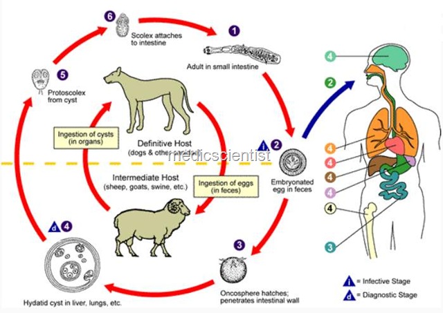 [ECHINOCOCCOSIS OR HYDATID DISEASE hg[4].jpg]