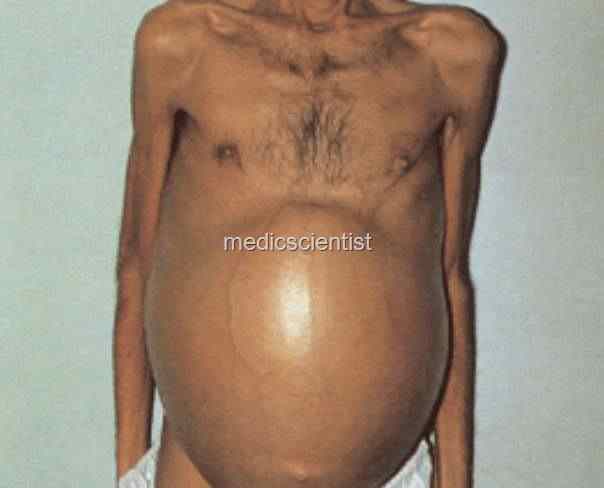 external image Schistosomiasis%20%20Flat%20Worm%20h_thumb.jpg?imgmax=800