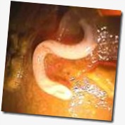 Trichuris no intestino com parte reprodutora em close. Trichuris no intestino com parte reprodutora em close.