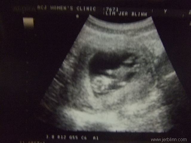 [Baby J 11 weeks[5].jpg]
