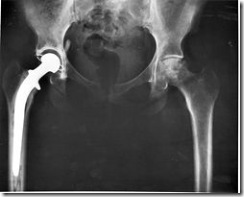 250px-Hip_replacement_Image_3684-PH