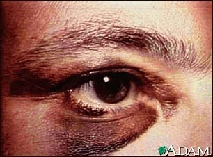 [blackeye[3].jpg]