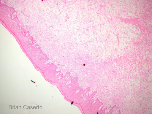 edematous gingiva
