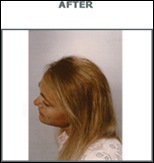 woman2-after