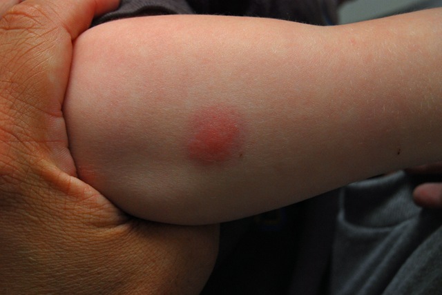 [spiderbite33.jpg]