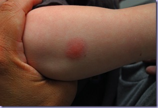 spiderbite3
