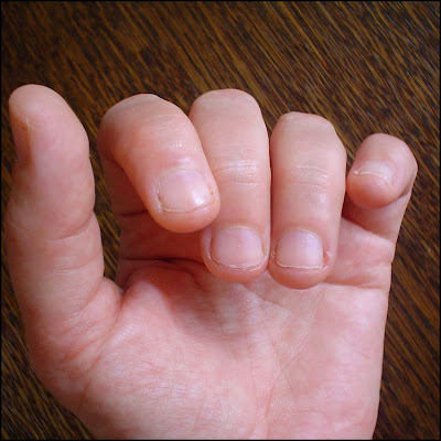 Nagels Bijten