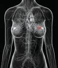 [breast cancer[4].jpg]
