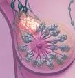 [breast cancer14[9].jpg]