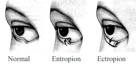 [Eyelids-Normal-Entropion-Ectropion[3].jpg]