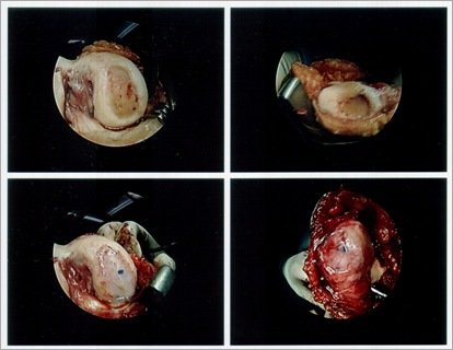 ACI implant on condyle and patella ACI implant on condyle and patella
