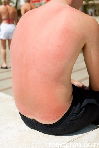 the danger of the suns rays