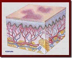 purpura purpura