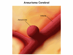 aneurisma aneurisma