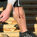 Kory's worksite injury 2/6