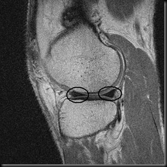 Knee0002