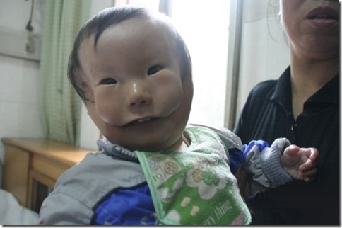 Transverse facial cleft  Boy Photo 4