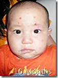 I am down with Chicken Pox!