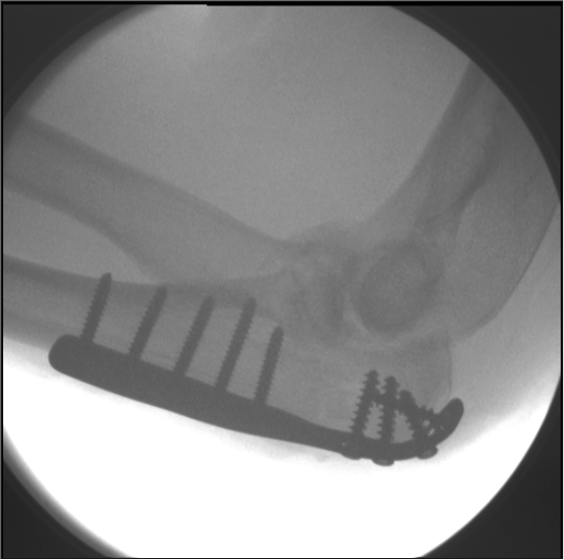 Broken+Ulna+Dislocated+Elbow ... meandmyinterest.blogspot.com/2011/07/broken-ulna-dislocated-elbow.html