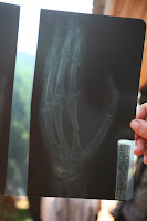 Broken hand