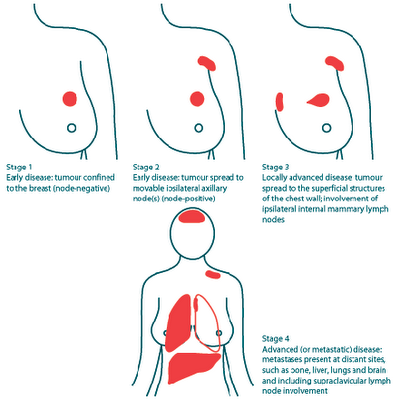 inflammatorisk bröstcancer symtom inflammatorisk bröstcancer symtom